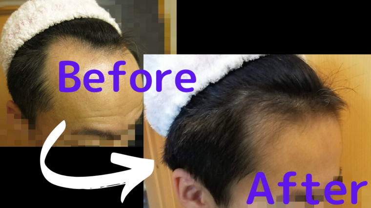 AGA治療開始前と1年後の写真