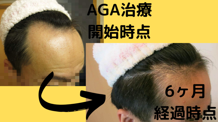 AGA治療開始前と6ヶ月の比較写真